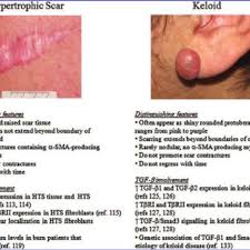 So many of you come in for me to take at look at your piercing to see if the bump that is forming is part of an infection, a keloid or something else. Characteristics Of Human Hypertrophic Scars And Keloids A Download Scientific Diagram
