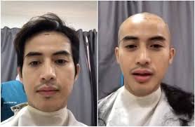 Apakah botak yang sudah licin (botak habis) bisa disembuhkan? Zoey Rahman Botak Kepala Tanam Rambut Kenapa Mata Bengkak Kitareporters Semua Boleh Jadi Reporter