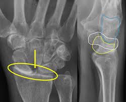 Image result for Scapholunate Dislocation