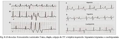 Image result for Extrasystole