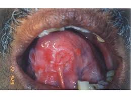 Image result for lichen planus on tongue)