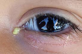 Four Risks of Colored Contacts - American Academy of Ophthalmology