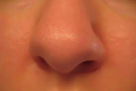 It's not clear what causes nasal polyps. Types Of Earaches Ent Buffalo Ny Dr Paul Young Md