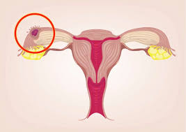 How painful is an ectopic pregnancy? Ectopic Pregnancy Symptoms Risk Factors And Treatment
