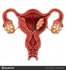 A hormonokkal történő kezelés célja a peteérés meggátlása, lehetőleg hosszútávon, ez az endometriózis visszafejlődését idézi elő a kezelés ideje alatt, és további néhány hónapra a kezelés abbahagyása után is. Endometrium Daganatok Endometriumrak Tunetei Kivizsgalasa Endometrium Rak Endometriosis