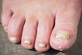 Black toenail fungusdo you have black toenail fungus? Fungal Nail Infections Health Navigator Nz