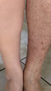 Image result for liver spots on legs