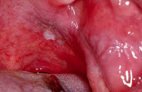 Image result for Physical injury red spots roof of mouth
