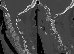 Lombaire ceinture dorsale de décompression de la ceinture arrière de protect mkl. Fracture Cervicale Realites Biomedicales
