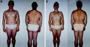 Congenital generalized lipodystrophy (gld) is a rare autosomal recessive disease characterized by near absence of adipose tissue from birth or early infancy and severe insulin resistance. Lipodystrophy Lipodystrophy Syndrome Causes Symptoms And Treatment