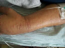 Lymph nodes are critical to the body's immune response, and so they commonly swell in reaction to infection and other causes. Lymphoma Rash Pictures Diagnosis And Treatment