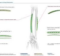 Anatomic Radius Volar Locking Plate,Medical Device ...