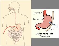 Image result for Enterostomy