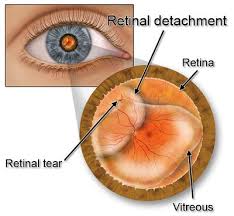 Retinal detachment is a condition in which the neurosensory retina is separated from the retinal pig­ment epithelium. Retinal Detachment Surgery Top Rated Doctor Nyc Ophthalmologist