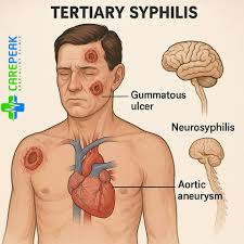 Image result for Tertiary Syphilis