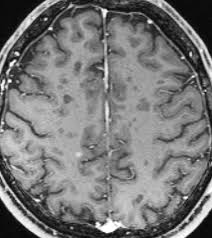 Das Ruckenmark Als Schlussel Zur Ms Diagnostik Healthcare In Europe Com