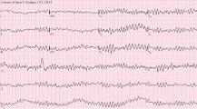 Image result for icd 10 code for vfib arrest