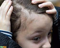 Life with hair loss from scalp ringworm irradiation in childhood has a negative impact on women's health status and psychosocial state. Stop Childhood Hair Loss Due To Tinea Capitis Vs Alopecia Areata Vs Trauma Or Traction Damage And 1 More Visihow