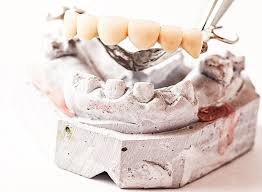 Was ist eine zahnkrone und wann wird sie als zahnersatz verwendet? Zahnrestauration Plombe Krone Oder Brucke Gesund Co At