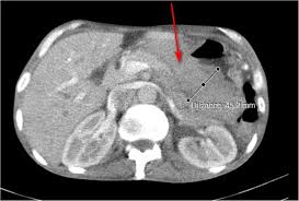 Cancerous cells that are present in the inner lining of the stomach form the basis of stomach cancer or gastric cancer. Diagnosis Of Gastric Cancer By Mdct Gastrography Diagnostic Characteristics And Management Potential Egyptian Journal Of Radiology And Nuclear Medicine Full Text