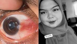 Pada istilah medis, mata kedutan sering dikenal sebagai biasanya, mata kiri kedutan terjadi akibat aktivitas yang dijalani setelah seharian penuh. Diabetes Beri Kesan Kepada Mata