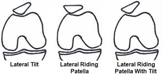 Image result for Patellar Tilt Test