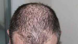 About 55 percent of women experience some hair loss by the age of 70. Lmrxsa078xscmm