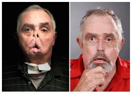 Neither desjardins nor his wife were present wednesday, but borsuk as for the ethics of transplanting another human's face, borsuk said he didn't view it as different from any other transplant, adding the face has taken on an. First Canadian Face Transplant A Success Hospital News Face Transplant