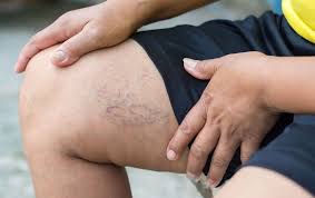How can you make veins more prominent? Why Are My Veins Blue And Green Usa Vein Clinics