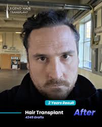 ✨ 12 Months. Perfect Hairline. Confident You. ✨ When hair restoration meets  expert hands