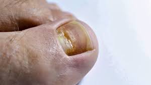 Image result for Beau lines feet