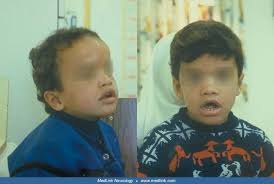 Central precocious puberty is also frequently encountered in these children, typically in patients with sessile tumors. Acrocallosal Syndrome Medlink Neurology