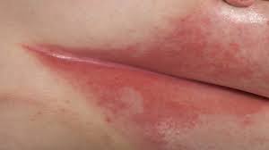 Image result for Intertrigo under breasts