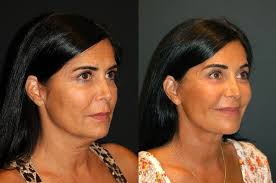 Andrew Jacono, MD-The New York Center for Facial Plastic and Laser Surgery  added a new photo — at Andrew Jacono, MD-The New York Center for Facial  Plastic...