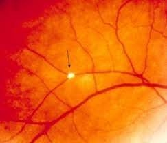 The Three Early Signs Of High Cholesterol You Can Notice In Your Eyes Irish Mirror Online
