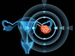 Why Ovarian Cancer Is So Hard To Detect Smgwh