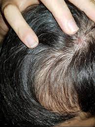 A tender scalp is something that some of us may have experienced at least once in the past. Painful Spot On Scalp Snd Hair Loss Hi I Can T See My Skin