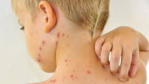 Infeksi virus merupakan penyakit infeksi yang disebabkan oleh masuknya virus ke dalam tubuh manusia. Kenali Beda Cacar Monyet Dan Cacar Air