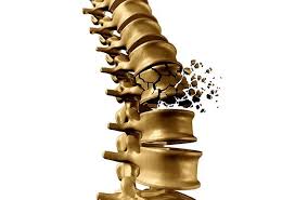 Image result for Vertebral Compression Fracture