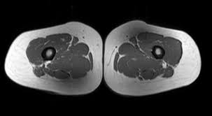 What other tests should i have? Quantifying Fat Replacement Of Muscle By Quantitative Mri In Muscular Dystrophy Springerlink