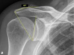 Das schulterdach ist „hakenförmig verändert. Lateral Acromioplasty For Correction Of The Critical Shoulder Angle Deutsches Schulterzentrum