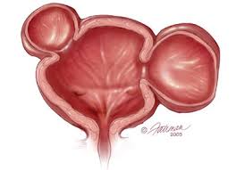 Bladder Diverticulum Symptoms Diagnosis Treatment Urology Care Foundation