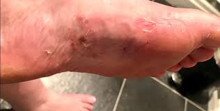 Image result for pompholyx soles of feet