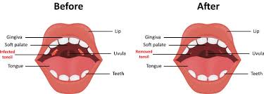 What To Expect After Your Tonsillectomy Bergerhenry Ent
