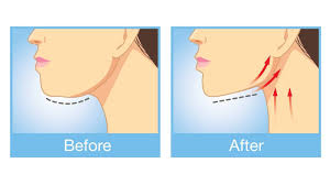 Turkey neck, neck waddle, sagging neck. The 7 Most Effective Methods To Get Rid Of A Double Chin