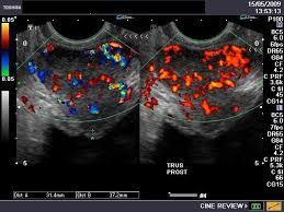 Ultrasound uterine and ovarian vascularity. A Gallery Of High Resolution Ultrasound Color Doppler 3d Images Prostate Ultrasound Mens Tops Mens Tshirts
