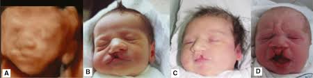 Diagnosis Of Fetal Syndromes By Three And Four Dimensional Ultrasound Is There Any Improvement