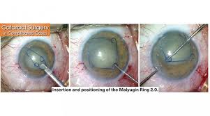 Image result for Cataract Extraction
