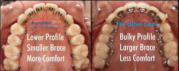 It's pretty much impossible to get a string of floss in between your teeth without a floss threader. Invisible Braces Are Here Introducing Lingual Behind The Teeth Braces Passamano Orthodontics