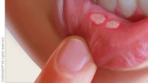 Check spelling or type a new query. Canker Sores For Parents Nemours Kidshealth